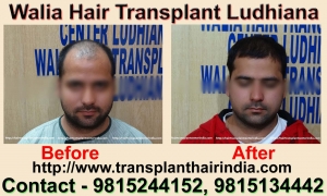 Hair Transplant in India Ludhiana Punjab 9815244152